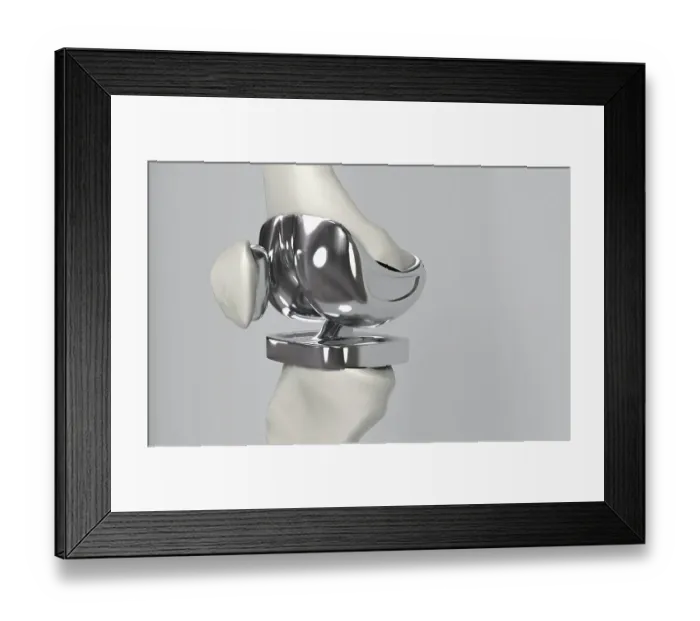Framed Print : Knee replacement Framed Print : Knee replacement
