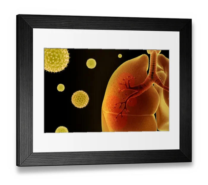 Framed Print : Asthma. allergic, allergies, allergy, anatomy Framed Print : Asthma. allergic, allergies, allergy, anatomy