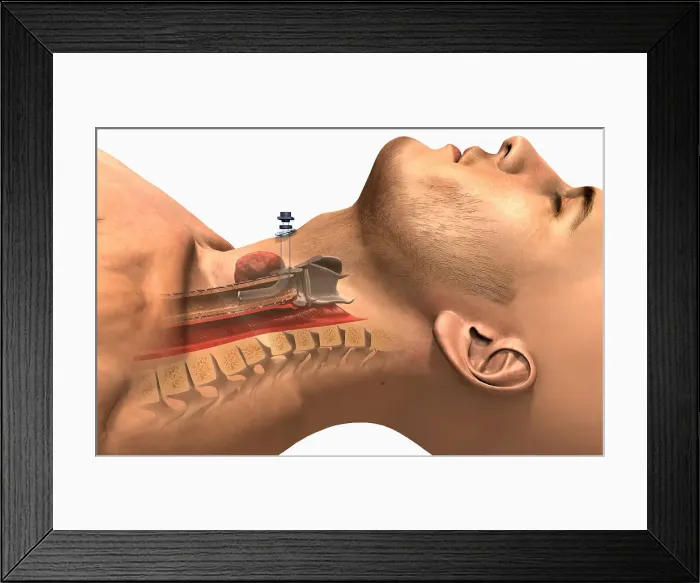 Framed Print : A lateral view of the tracheostomy procedure Framed Print : A lateral view of the tracheostomy procedure