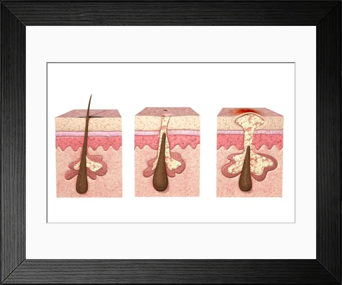 Framed Print : Acne. acne, blackhead, dermis, epidermis, follicle Framed Print : Acne. acne, blackhead, dermis, epidermis, follicle