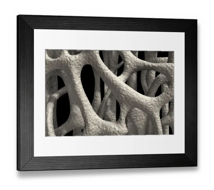 Framed Print : Osteoporosis Framed Print : Osteoporosis