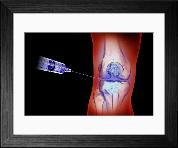 Framed Print : Knee injection