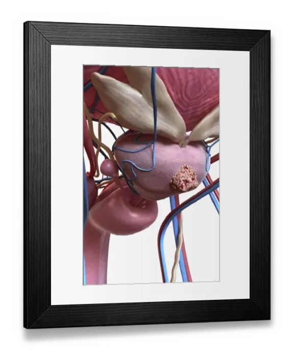 Framed Print : Prostate cancer Framed Print : Prostate cancer