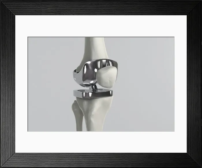 Framed Print : Knee replacement Framed Print : Knee replacement