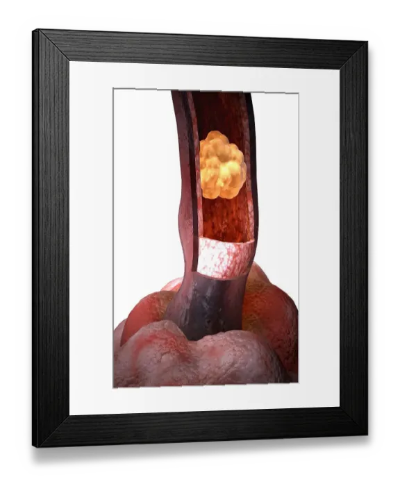 Framed Print : Cystic fibrosis Framed Print : Cystic fibrosis