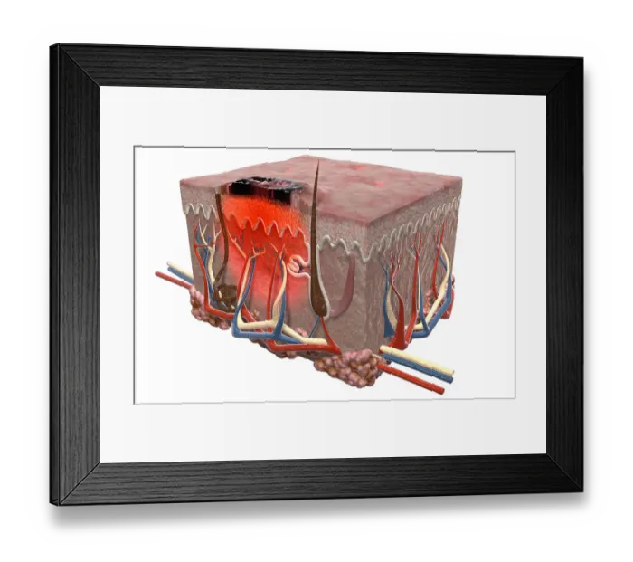 Framed Print : Malignant melanoma Framed Print : Malignant melanoma