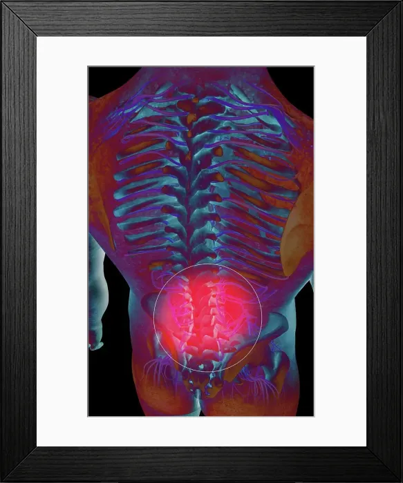 Framed Print : Back pain. A posterior view of a male torso revealing the skeletal Framed Print : Back pain. A posterior view of a male torso revealing the skeletal