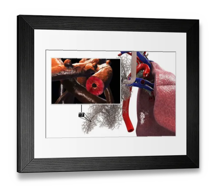 Framed Print : A section of an asmathic broncheoli