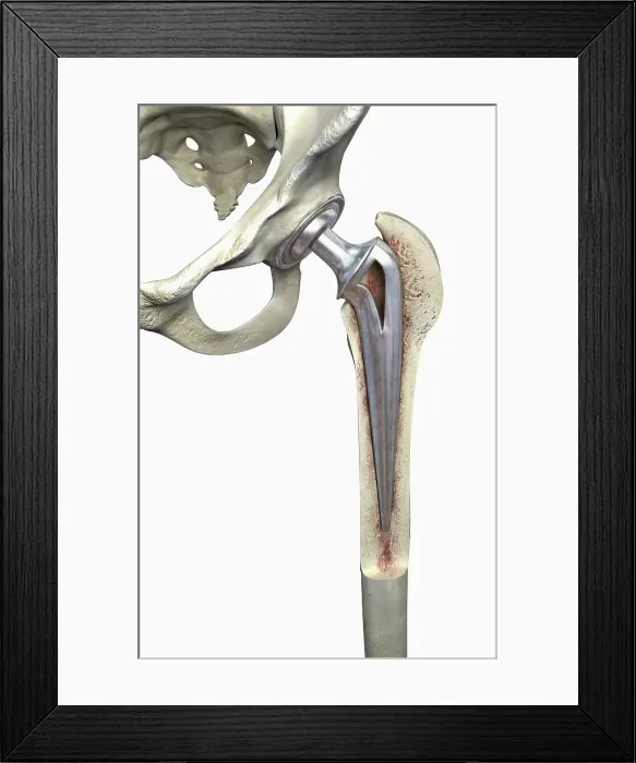 Framed Print : Hip replacement Framed Print : Hip replacement