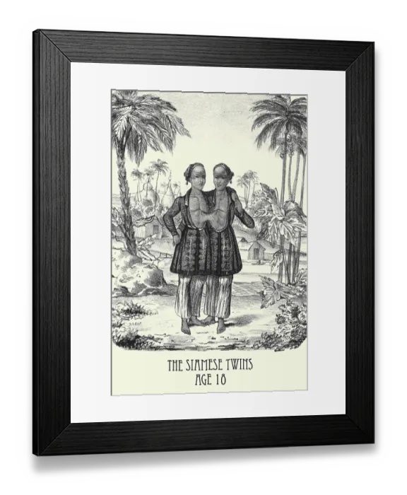 Framed Print : The Siamese Twins age 18 Framed Print : The Siamese Twins age 18