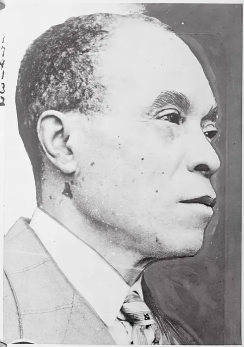 Framed Print : African American Suffering from Rare Skin Disease Framed Print : African American Suffering from Rare Skin Disease