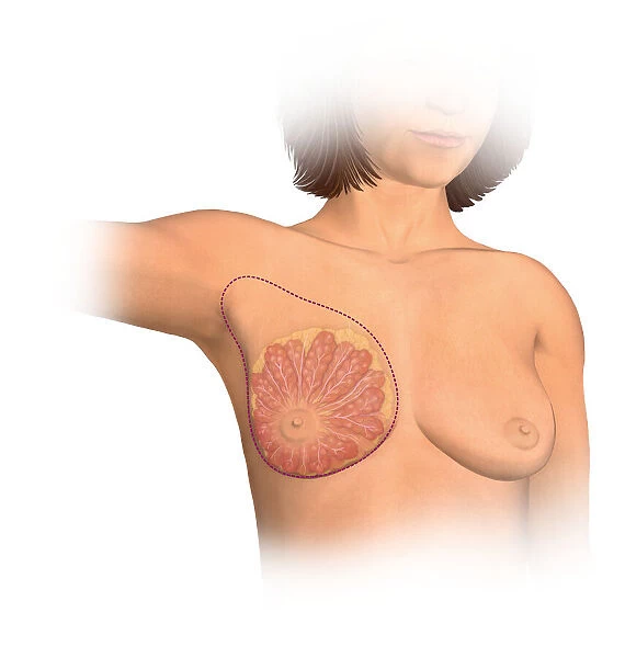 Anterior view female anatomy showing breast tissue and muscle affected by a simple