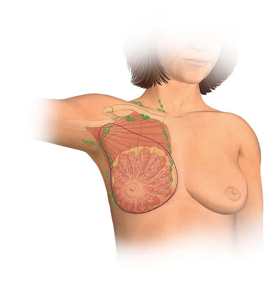 Anterior view female anatomy showing breast tissue and muscle affected by a radical