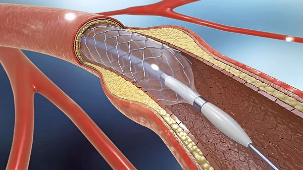 Arterial stent, illustration