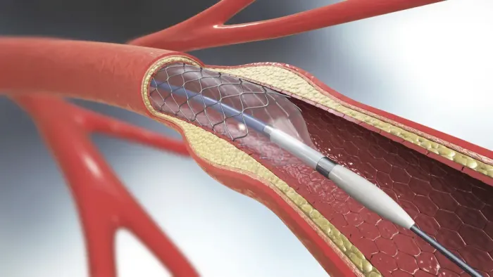 Framed Print : Arterial stent, illustration Framed Print : Arterial stent, illustration