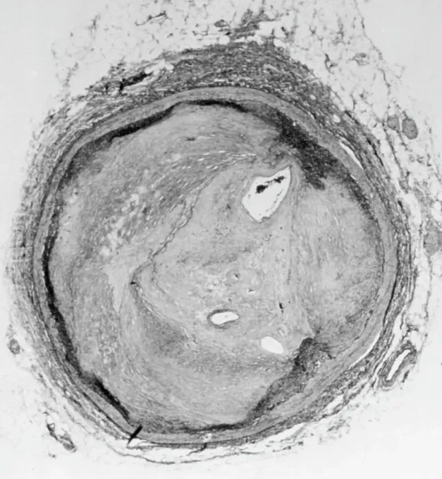 Framed Print : Arteries Choked By Plaque, Cholesterol Framed Print : Arteries Choked By Plaque, Cholesterol
