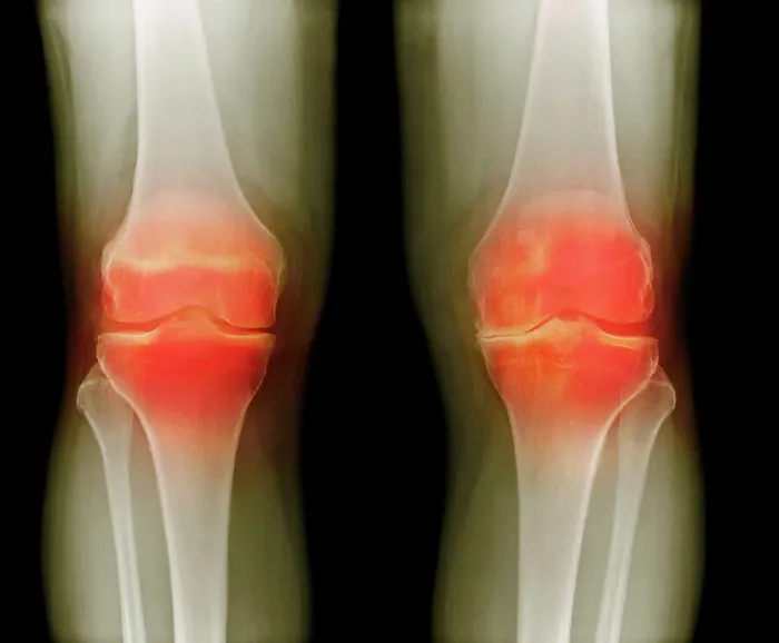Framed Print : Arthritic knees, X-ray Framed Print : Arthritic knees, X-ray