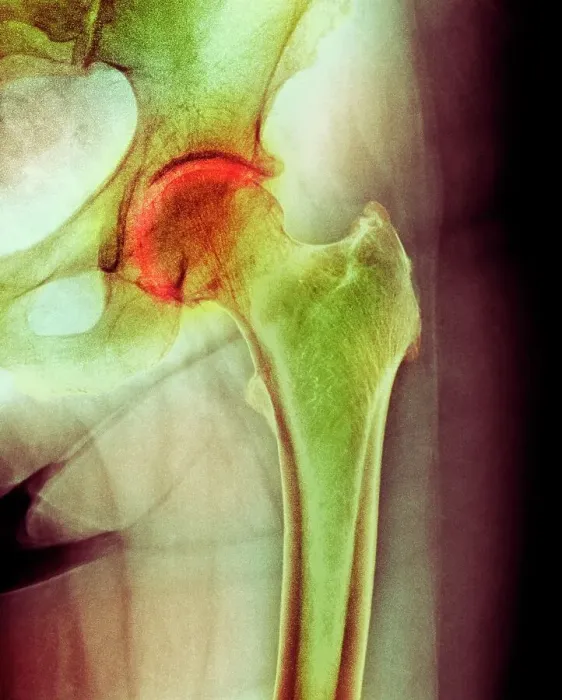 Framed Print : Arthritis of the hip, X-ray Framed Print : Arthritis of the hip, X-ray