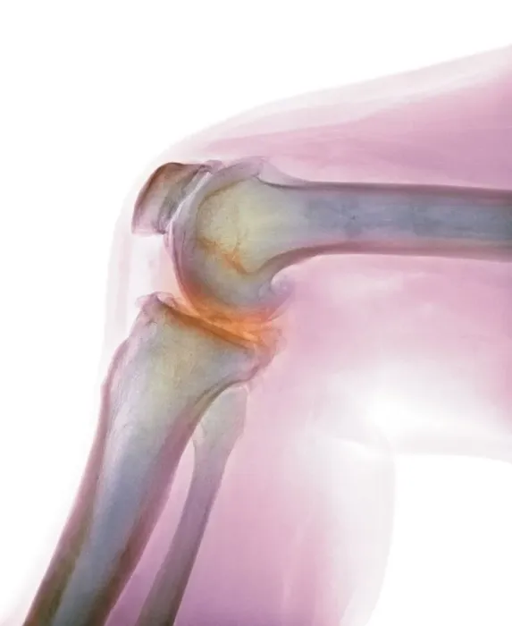 Framed Print : Arthritis of the knee, X-ray Framed Print : Arthritis of the knee, X-ray