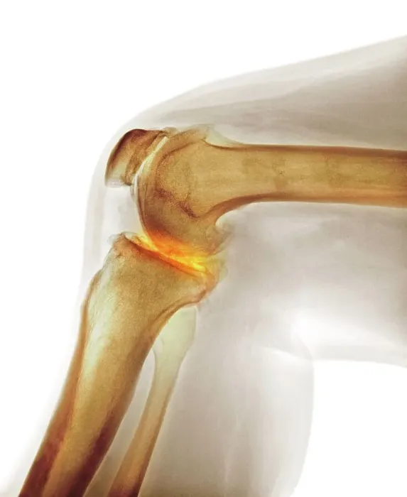 Framed Print : Arthritis of the knee, X-ray Framed Print : Arthritis of the knee, X-ray