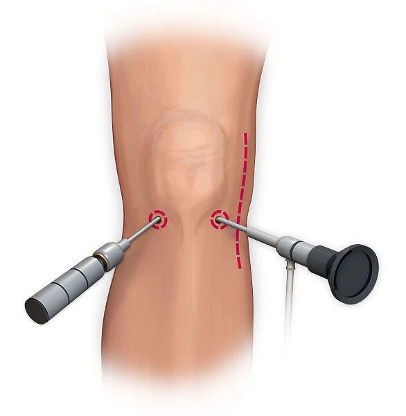 Arthroscopic surgical repair of the knee
