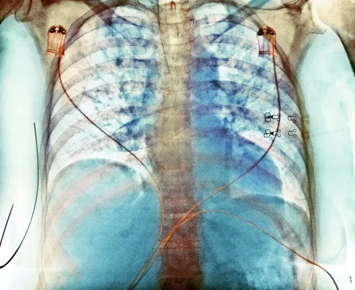 Framed Print : Aspiration, chest X-ray Framed Print : Aspiration, chest X-ray