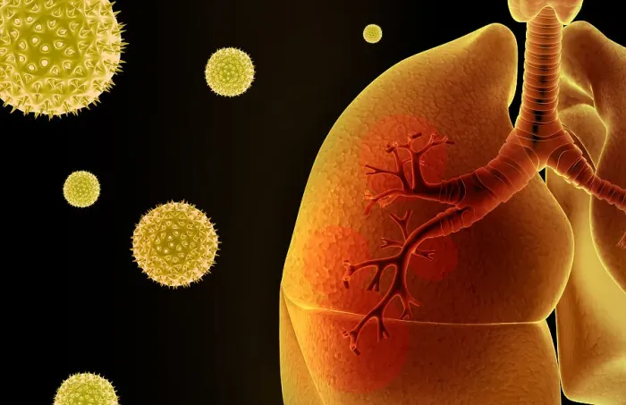 Framed Print : Asthma. allergic, allergies, allergy, anatomy Framed Print : Asthma. allergic, allergies, allergy, anatomy