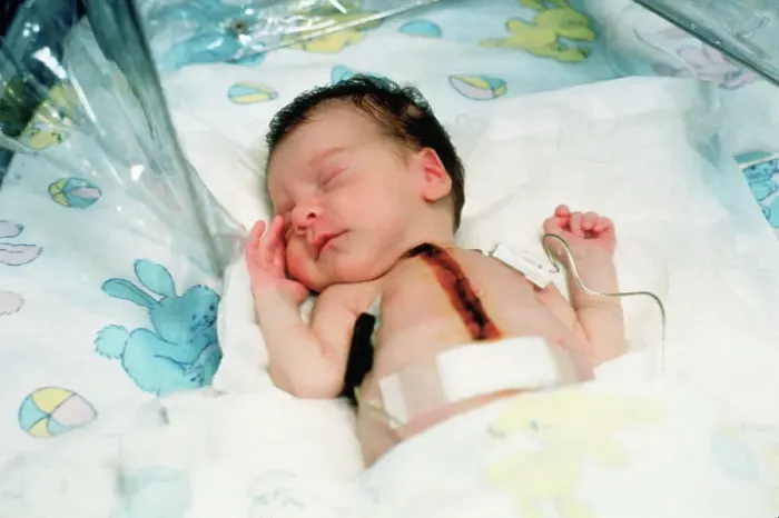 Framed Print : Baby Fae After Heart Transplant Framed Print : Baby Fae After Heart Transplant