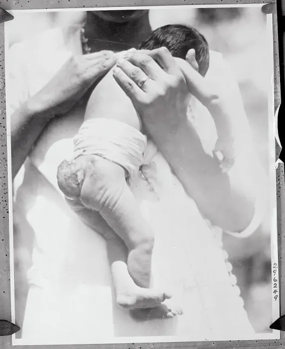 Framed Print : Baby Girl Born with Tail