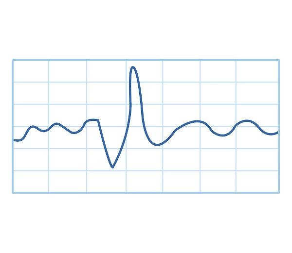 Biomedical illustration of electromyography (EMG) result
