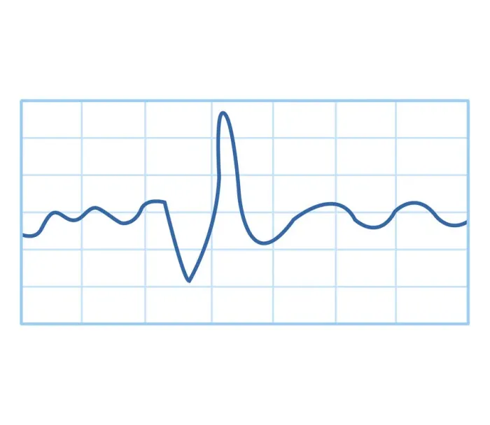 Framed Print : Biomedical illustration of electromyography (EMG) result Framed Print : Biomedical illustration of electromyography (EMG) result