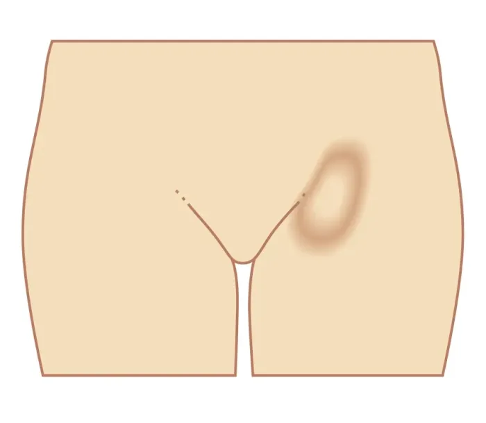 Framed Print : Biomedical illustration of femoral hernia in female