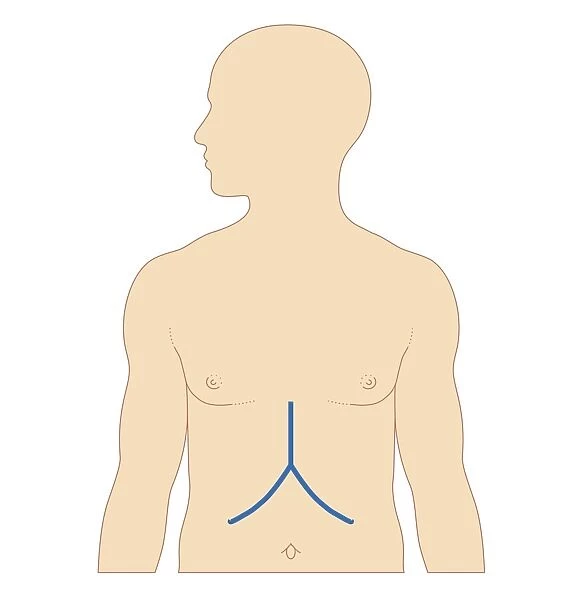 Biomedical illustration of incision site for liver transplant