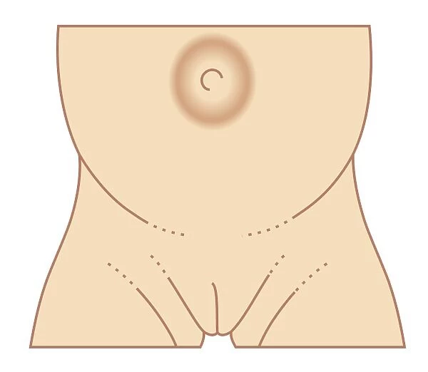 Biomedical illustration of umbilical hernia in female baby
