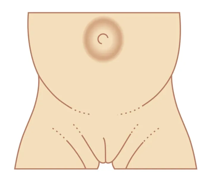 Framed Print : Biomedical illustration of umbilical hernia in female baby