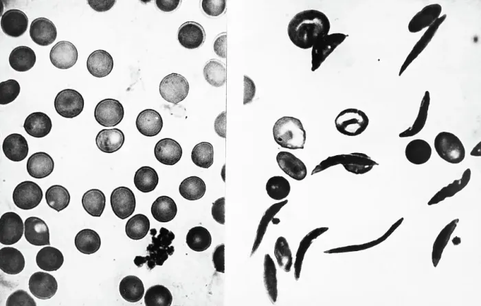 Framed Print : Blood Cells - Normal And Sickle Framed Print : Blood Cells - Normal And Sickle