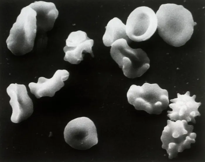Framed Print : Cells Deformed by Sickle Cell Anemia Framed Print : Cells Deformed by Sickle Cell Anemia