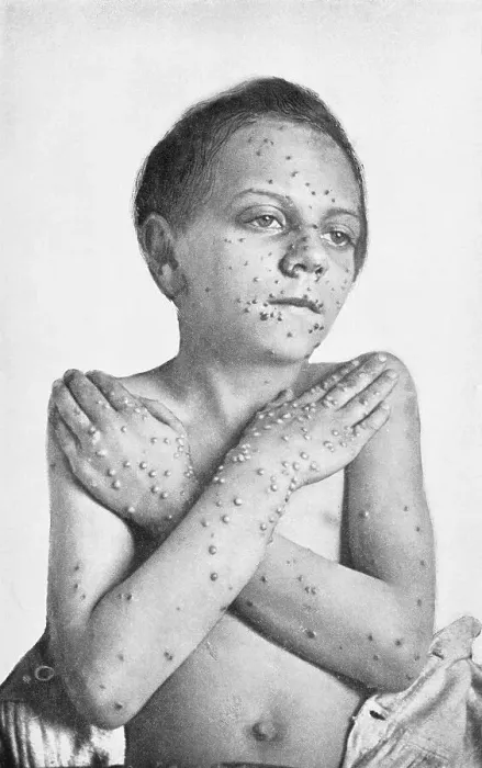 Framed Print : Child Stricken with Smallpox Framed Print : Child Stricken with Smallpox