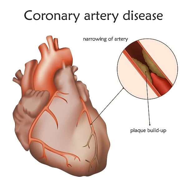 Coronary artery disease, illustration
