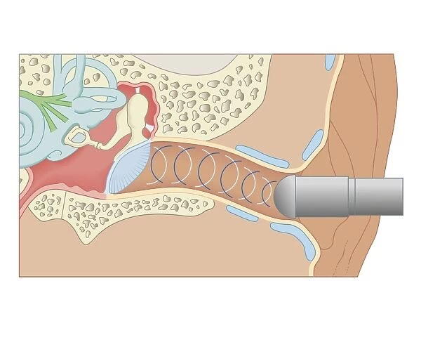 Cross section biomedical illustration of tympanometer probe inserted in ear to test middle ear and eardrum (Tympanometry)