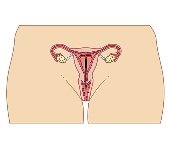 Cross section biomedical illustration of Intrauterine device (IUD) in position