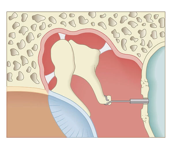 Cross section biomedical illustration of post-operative stapedotomy surgery