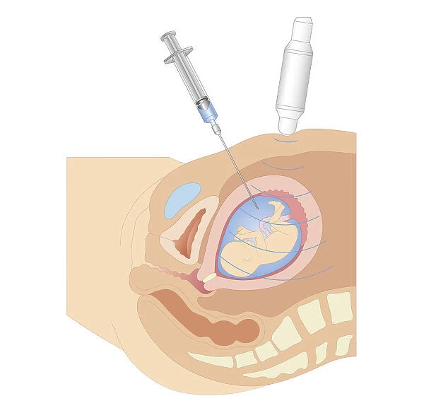 Cross section biomedical illustration of amniocentesis procedure