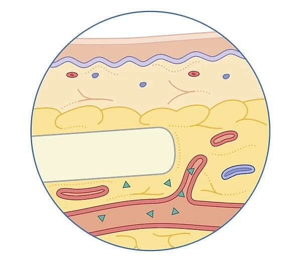 Cross section biomedical illustration of subcutaneous drug implanted or into fatty tissue just below the skin dispersing slowly into bloodstream