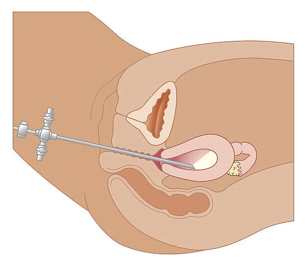 Cross section biomedical illustration of hysteroscopy procedure using endoscope