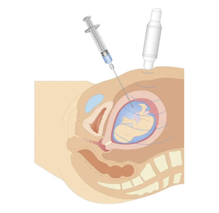Framed Print : Cross section biomedical illustration of amniocentesis procedure Framed Print : Cross section biomedical illustration of amniocentesis procedure