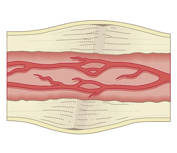 Cross section biomedical illustration of bone repairing itself with dense, compact bone gradually replacing the callus, and blood vessel regrowth