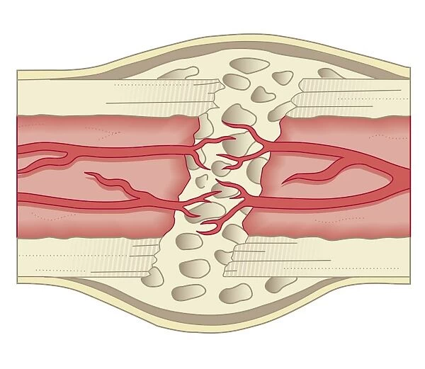 Cross section biomedical illustration of bone repairing itself with new, soft, spongy callus developing on framework provided by fibrous tissue, joining the broken ends