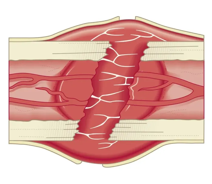 Framed Print : Cross section biomedical illustration of bone repairing itself with clot forming to seal broken blood vessels and fibrous tissue forming to replace the clot Framed Print : Cross section biomedical illustration of bone repairing itself with clot forming to seal broken blood vessels and fibrous tissue forming to replace the clot