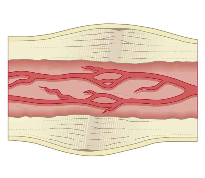 Framed Print : Cross section biomedical illustration of bone repairing itself with dense, compact bone gradually replacing the callus, and blood vessel regrowth